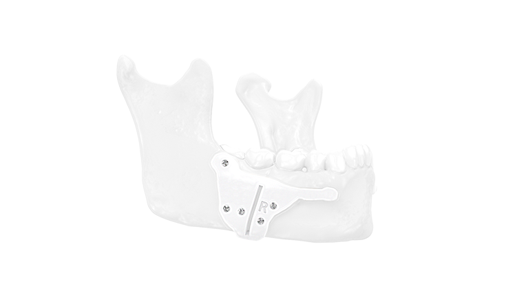 Insertion of the guides and performing the osteotomy