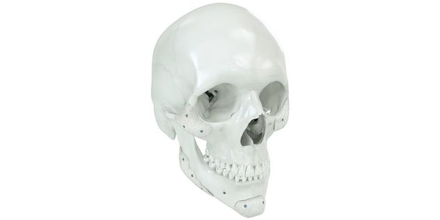 Onlays de polietileno (marPOR®)