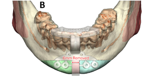 The amount of bone between the green and blue areas is resected.