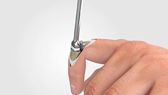 CapFlex PIP – Endoprosthetic treatment of the proximal interphalangeal joint (dorsal approach)