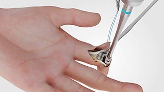 CapFlex PIP – Endoprosthetic treatment of the proximal interphalangeal joint (palmar approach)