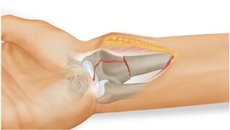Ixos® Radiusfraktur – Versorgung mit klassischer palmarer Platte