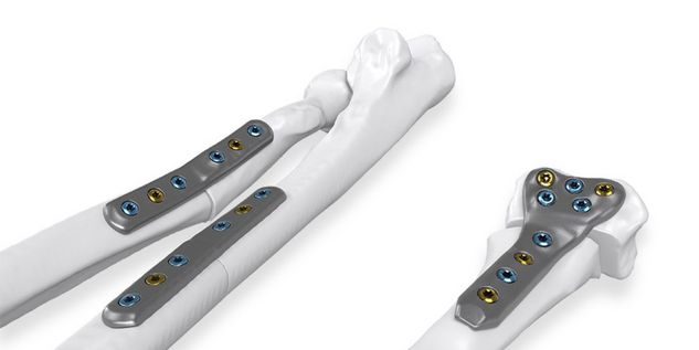 IPS® Radius Reconstruction