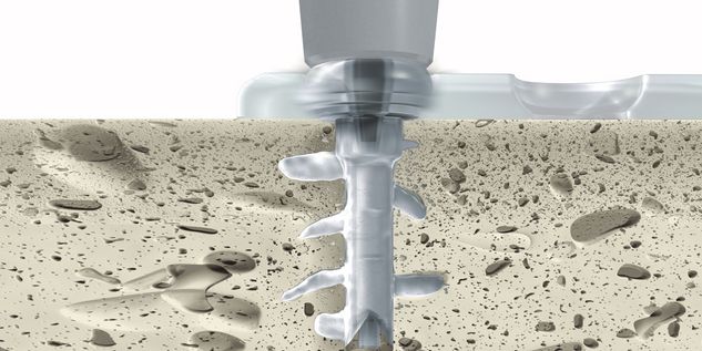 Insertion of SonicPin Rx®