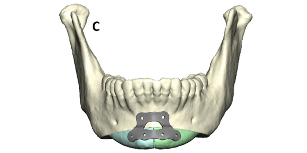 The custom implant is placed on the mandible and fixated. 