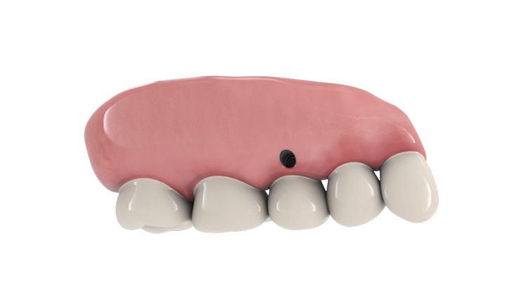 Erstellung des finalen Zahnersatzes