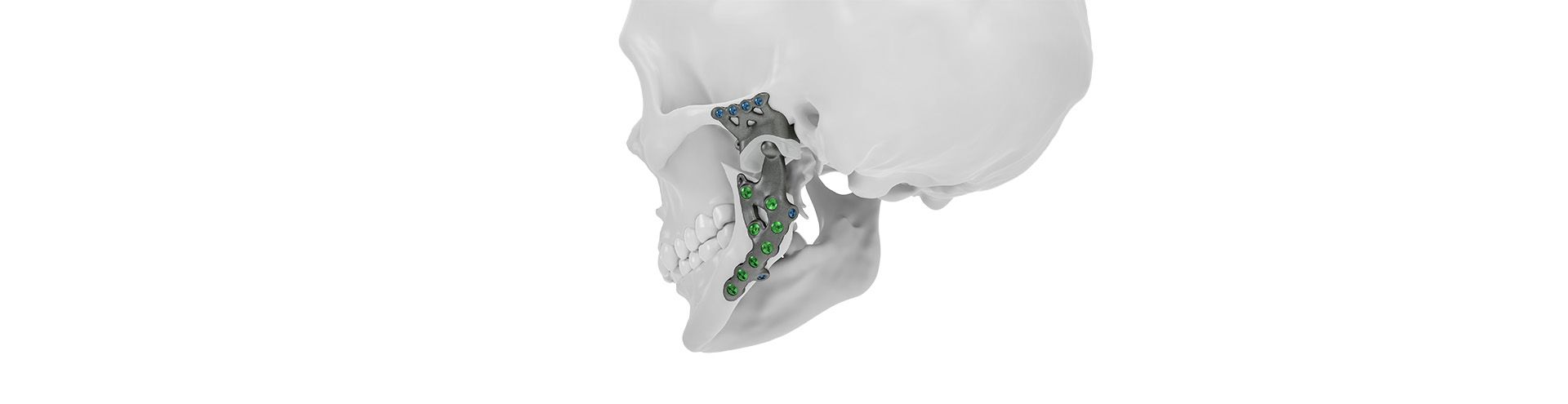 IPS Implants® TMJ Prosthesis