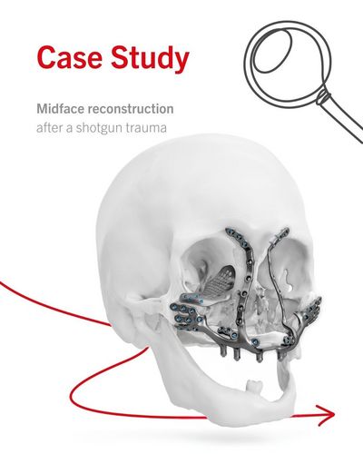 ✨ IPS® Preprosthetic planning – from trauma to reconstruction<br />
<br />
After multiple prior treatments using standard and IPS® Implants, this patient with severe shotgun-related facial trauma was managed using IPS® Preprosthetic.<br />
<br />
1️⃣ The preoperative situation required removal of an existing plate, a tooth, and bone fragments.<br />
2️⃣ Following plate removal, the scapula transplant could be repositioned. <br />
3️⃣The scapula transplant was integrated into the implant design, with bilateral fixation of the implant to the zygomatic regions.<br />
4️⃣Implant positioning was guided by virtual simulation of the upper and lower dentition. <br />
5️⃣Final planning included a detailed screw map with recommended screw lengths.<br />
6️⃣ After completion of the digital planning workflow, the custom‑made implant was manufactured and prepared for shipment.<br />
<br />
🔍 Precision planning<br />
🔧 Secure fixation<br />
🦴 Functional reconstruction<br />
<br />
Want to know more about our IPS® implants? Visit our website via the link in our bio!<br />
<br />
👉 The IPS® implants calendar 2026 is now available. It is the result of a special initiative in which IPS® Implants users submitted their most compelling clinical cases. Each month of the calendar features one selected patient case.