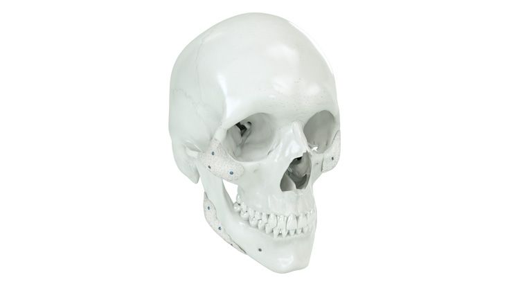 Individualisierte Implantate und Onlays