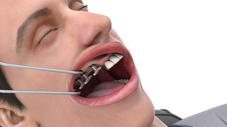 Start der finalen prothetischen Versorgung