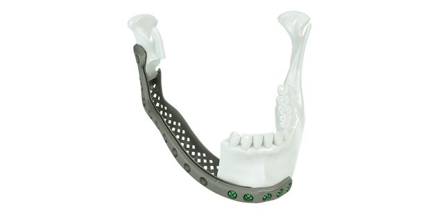 Bandeja de malla mandibular de titanio AM