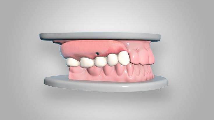 Digital design of the final denture