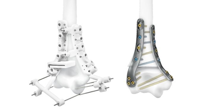 IPS Implants® Distal Humerus Reconstruction