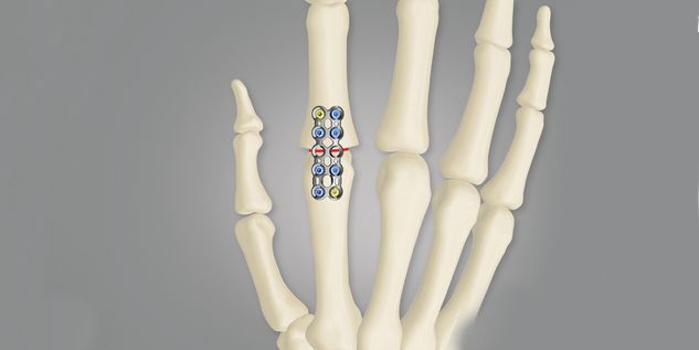 Arthrodesen