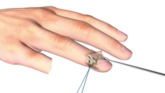 Linos – Strecksehnenabriss am Endglied