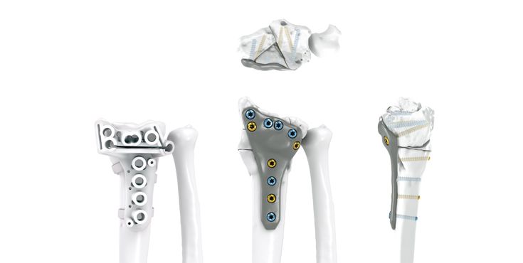 IPS Implants® Radius Reconstruction | Fallbeispiel 4