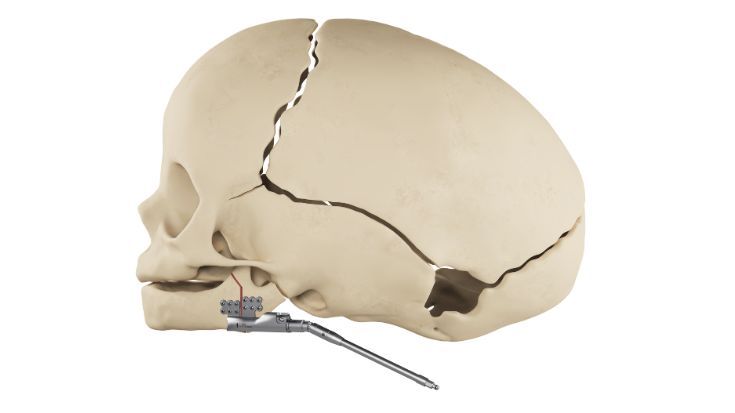 HyperDrive distractores mandibulares 