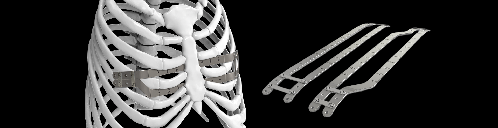 Pure Pectus: Raising the Bar in Pectus Excavatum Repair