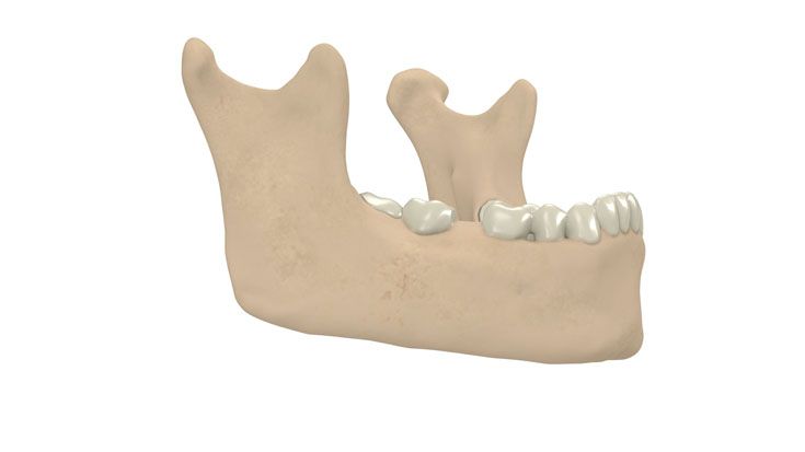 Removal of the distractor