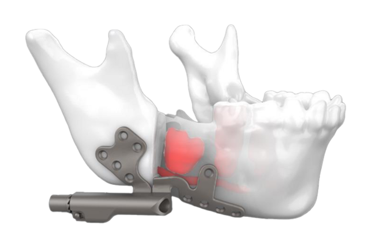 Optimal precision-fit