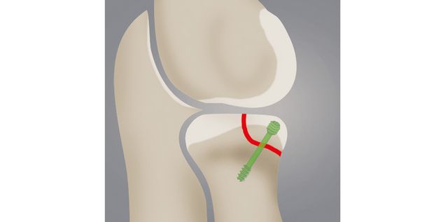 Proximale Radiuskopffraktur