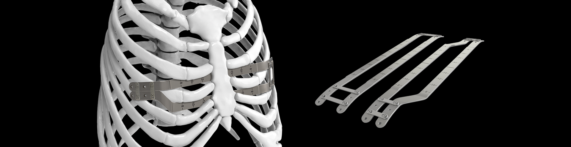 Pure Pectus: Raising the Bar in Pectus Excavatum Repair