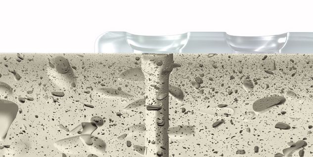 Insertion of SonicPin Rx®