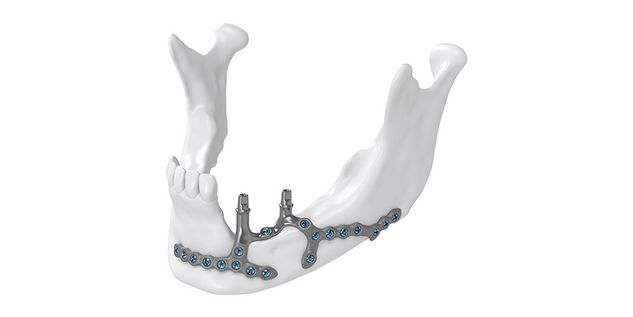 IPS Implants Preprosthetic