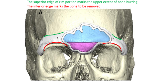Guide outlining the frontal sinus, areas of resection, and areas of burring.