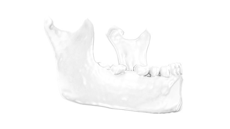 Removal of the distractor