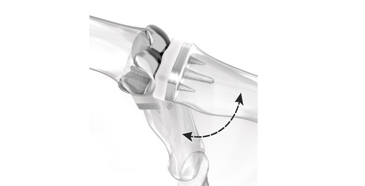 CapFlex PIP Joint Guide