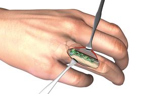 Linos - Schrägfraktur am Grundglied