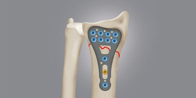 Type A2 Colles fractures