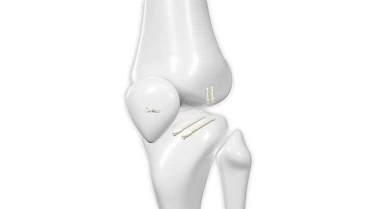 Anwendungsbereiche - Knie