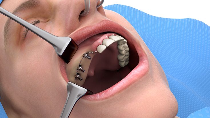 6. Weichgewebesituation