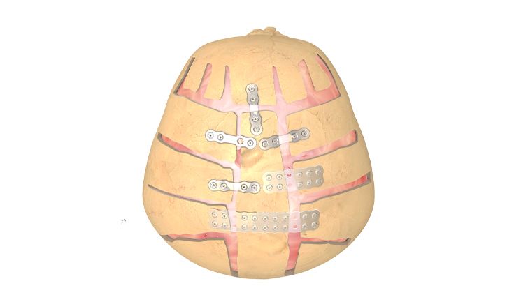 Osteotomía correctora craneofacial