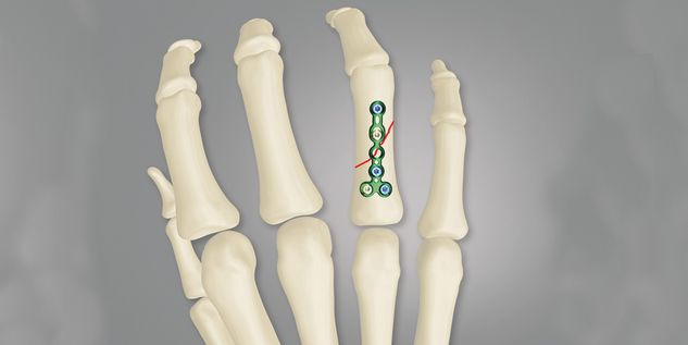 Phalangeal fractures