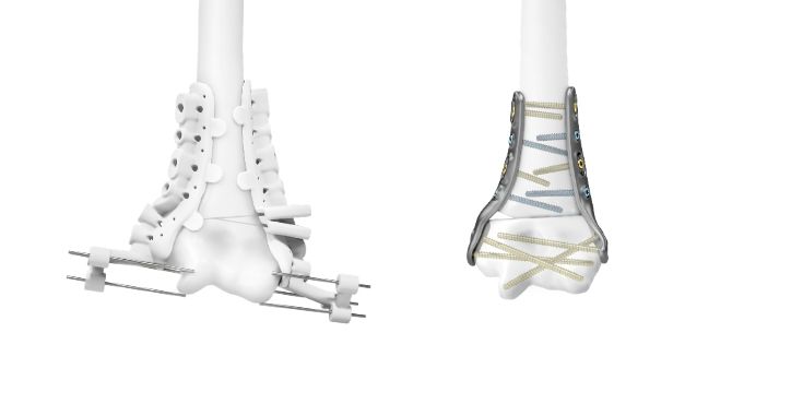 IPS Implants® Radius Reconstruction | Fallbeispiel 3