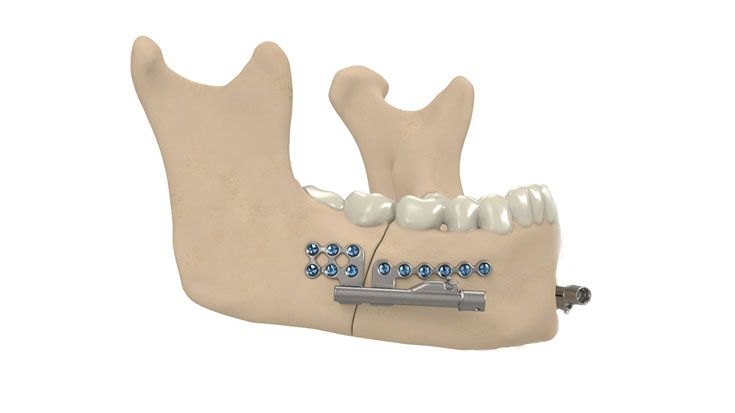Fixation of the distractors