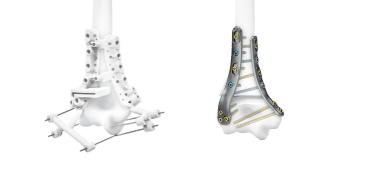 IPS Implants® Radius Reconstruction | Fallbeispiel 2