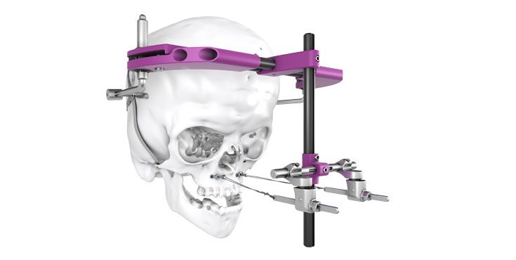 External midface distractor