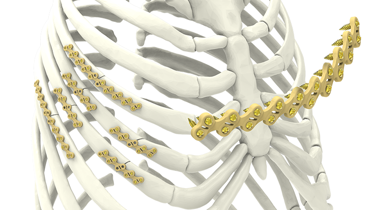 Self-Contouring plates adapt to the patient