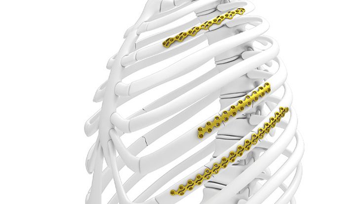 Implantate Traumatologie