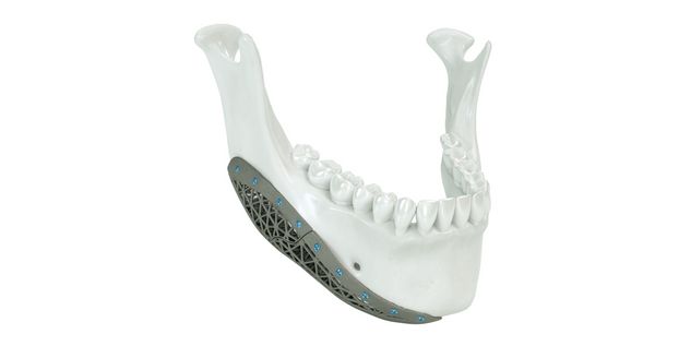 Onlay de mandíbula de titanio AM