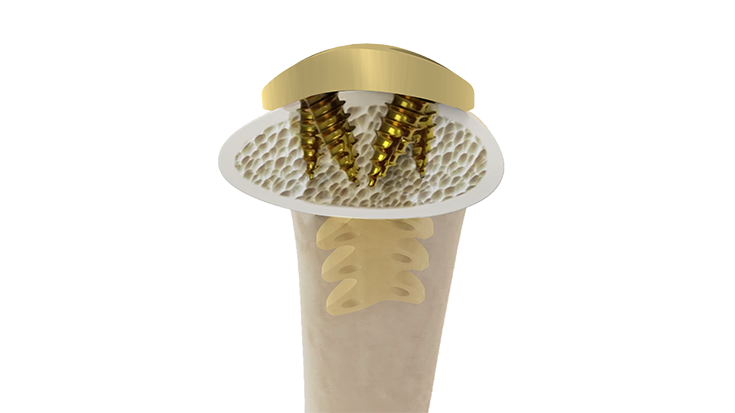 A different approach