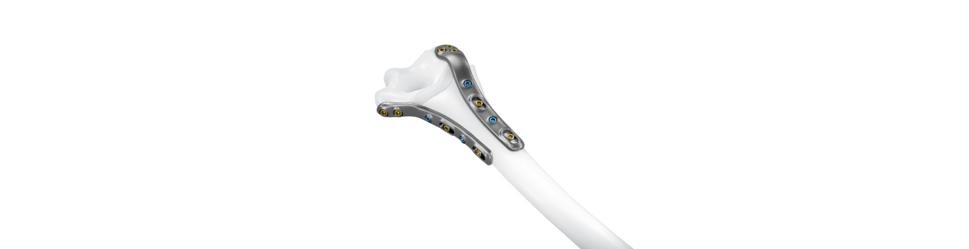 Kopfbild IPS Implants® Radius Reconstruction