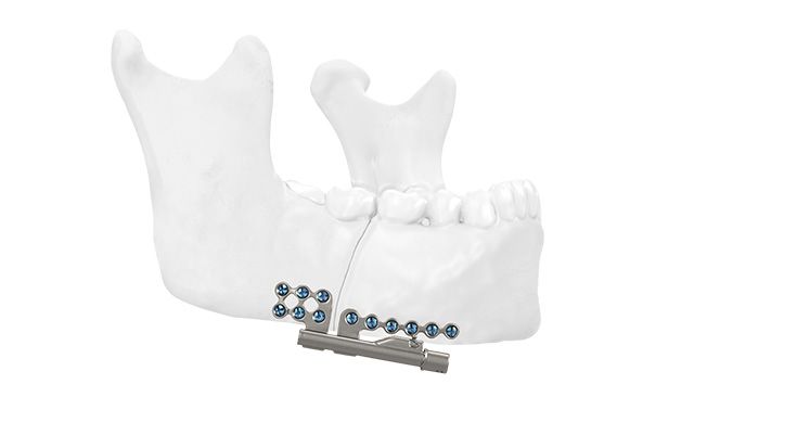 Fixation of the distractors