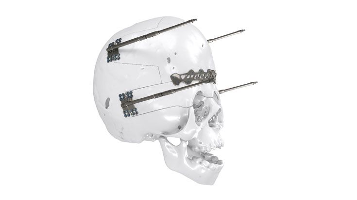 Multipart distraction of the cranium