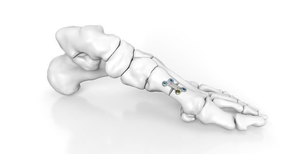 Hallux Valgus​