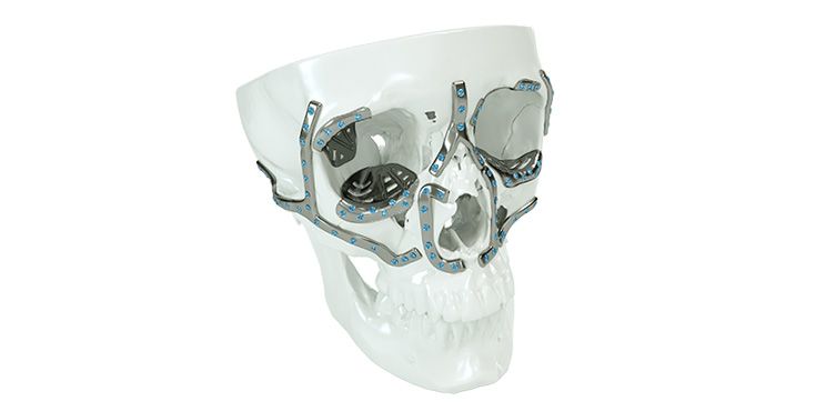 IPS Implants® Midface